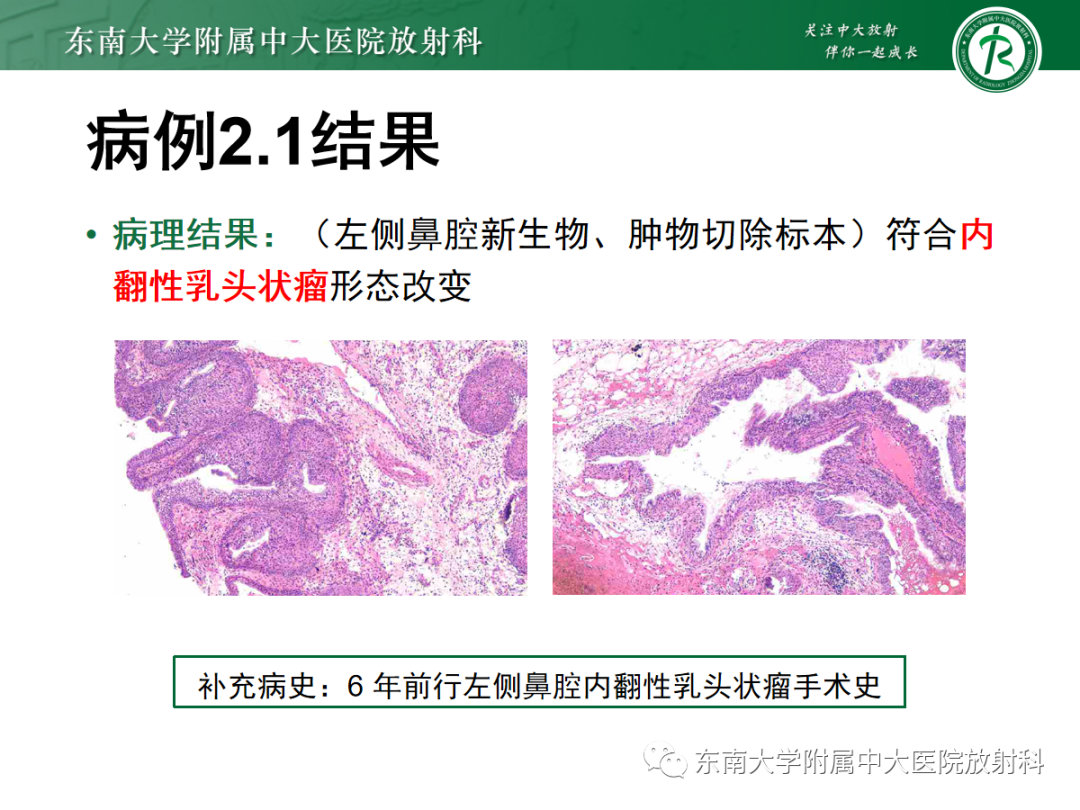影像PPT - 【PPT】以上颌窦为中心的鼻腔鼻窦占位性病变随访-57