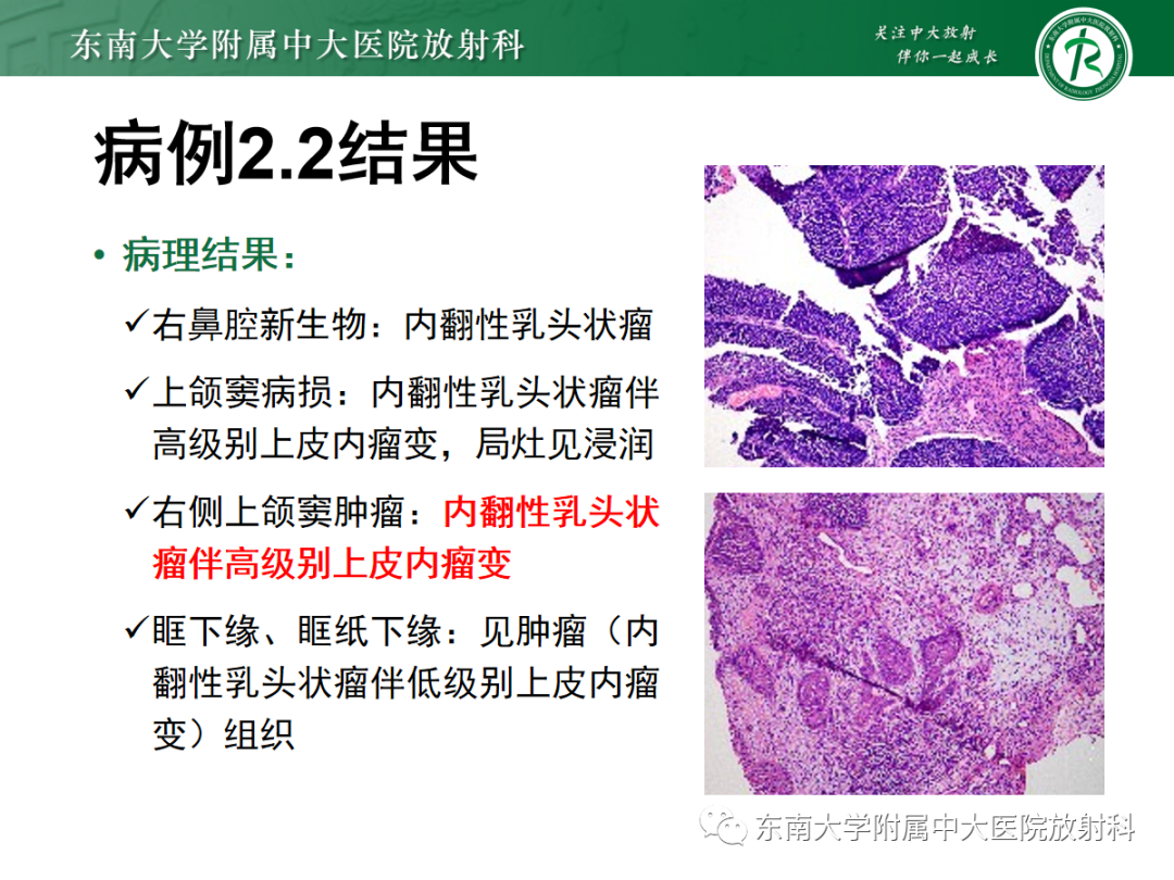 影像PPT - 【PPT】以上颌窦为中心的鼻腔鼻窦占位性病变随访-59