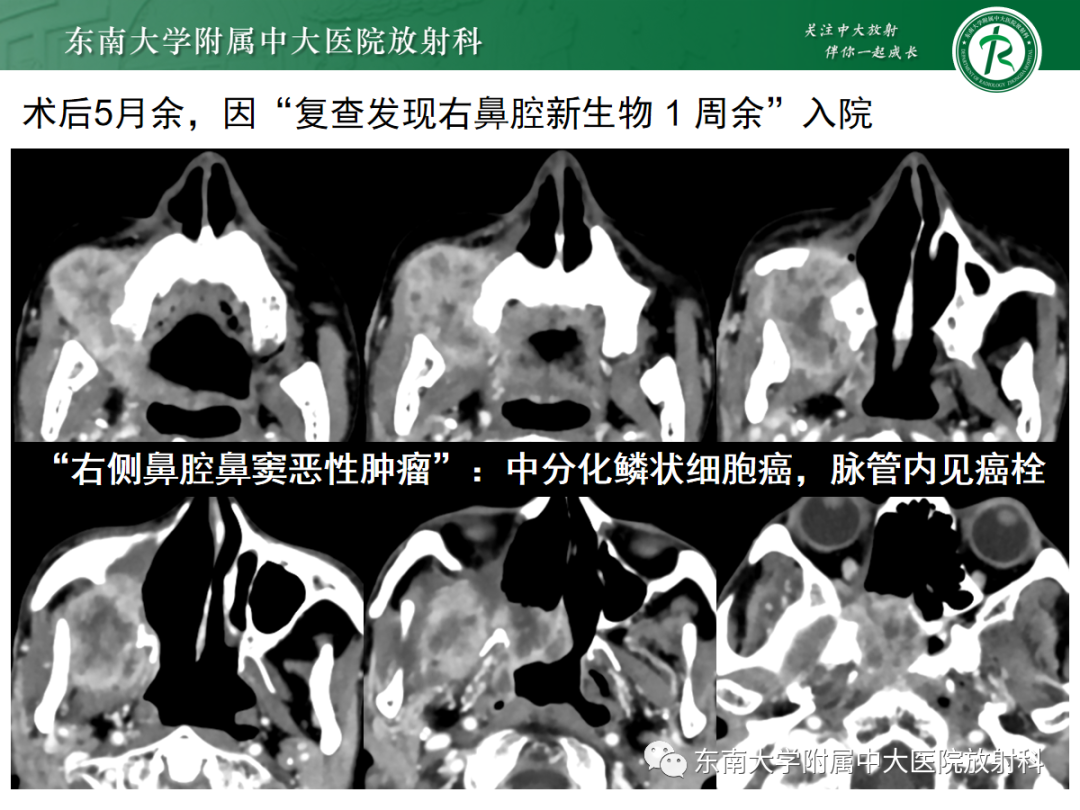 影像PPT - 【PPT】以上颌窦为中心的鼻腔鼻窦占位性病变随访-60