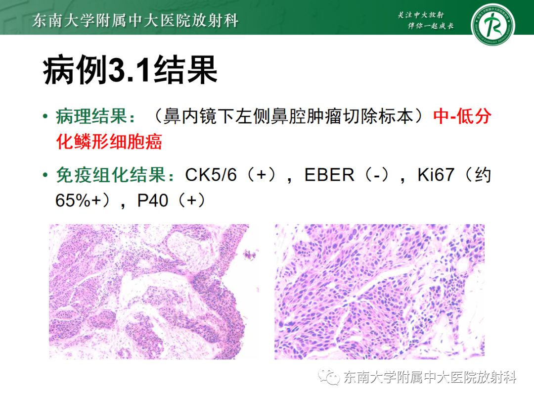 影像PPT - 【PPT】以上颌窦为中心的鼻腔鼻窦占位性病变随访-62