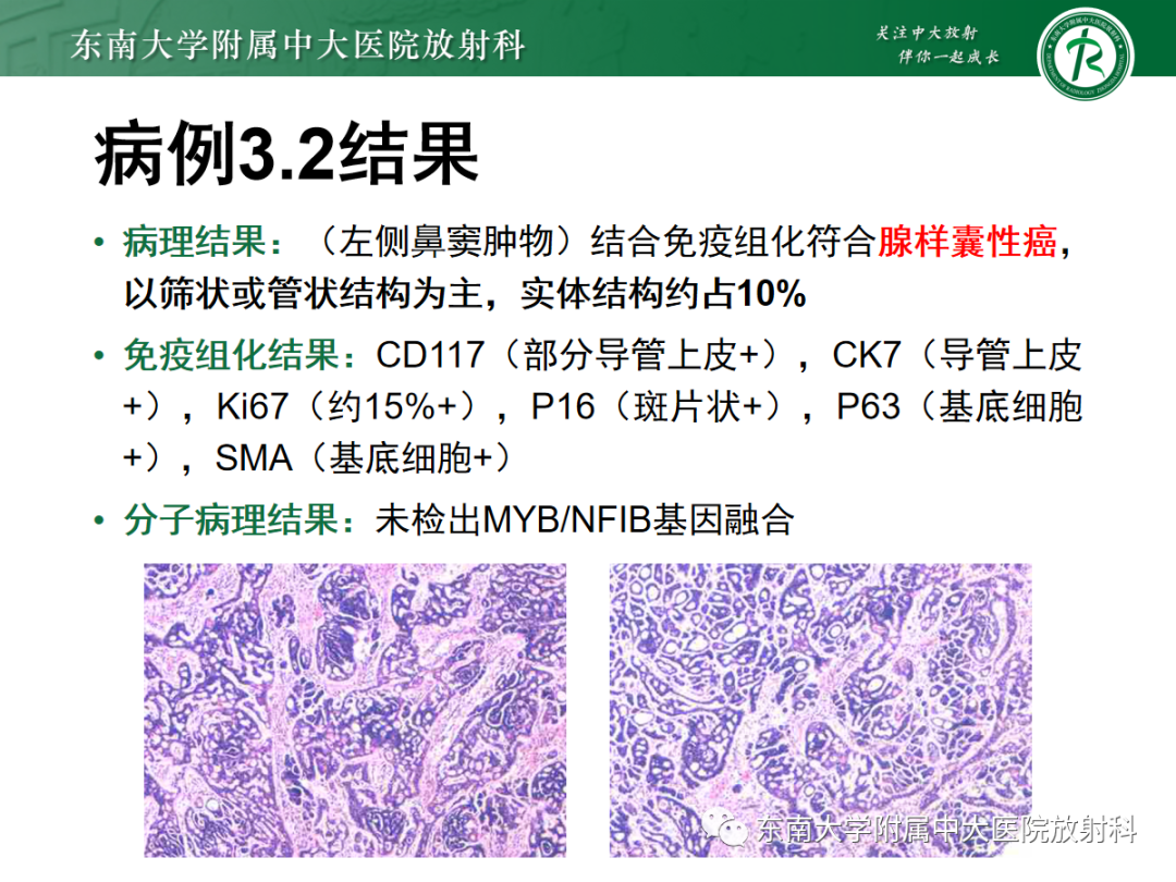 影像PPT - 【PPT】以上颌窦为中心的鼻腔鼻窦占位性病变随访-64