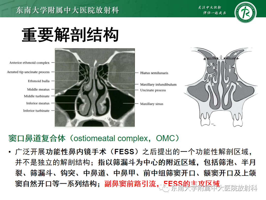 影像PPT - 【PPT】以上颌窦为中心的鼻腔鼻窦占位性病变随访-71