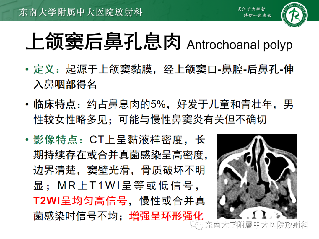 影像PPT - 【PPT】以上颌窦为中心的鼻腔鼻窦占位性病变随访-74