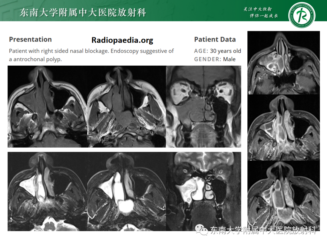 影像PPT - 【PPT】以上颌窦为中心的鼻腔鼻窦占位性病变随访-75