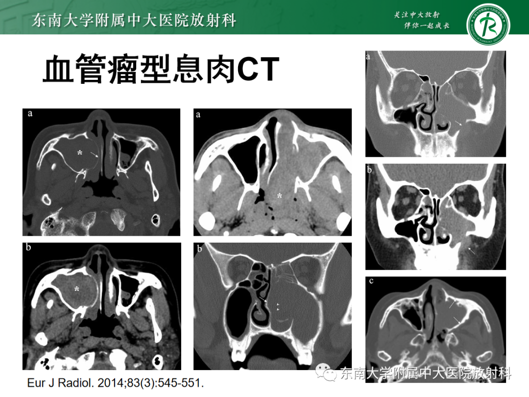 影像PPT - 【PPT】以上颌窦为中心的鼻腔鼻窦占位性病变随访-80