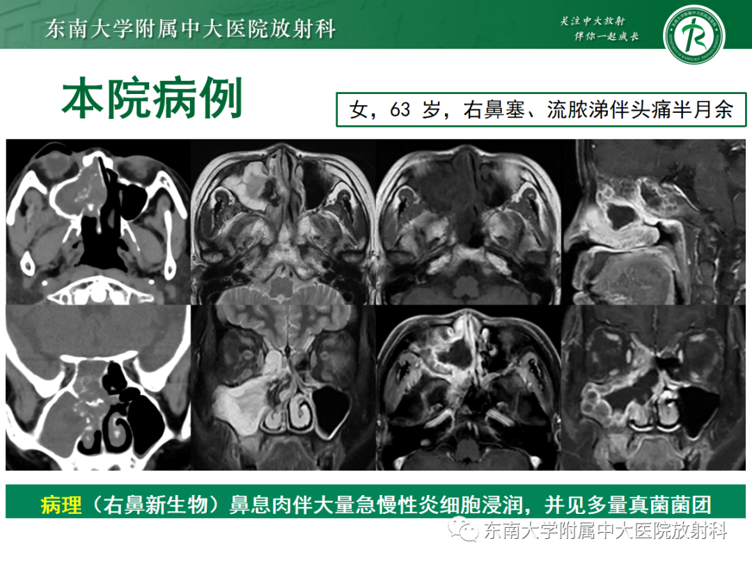 影像PPT - 【PPT】以上颌窦为中心的鼻腔鼻窦占位性病变随访-77