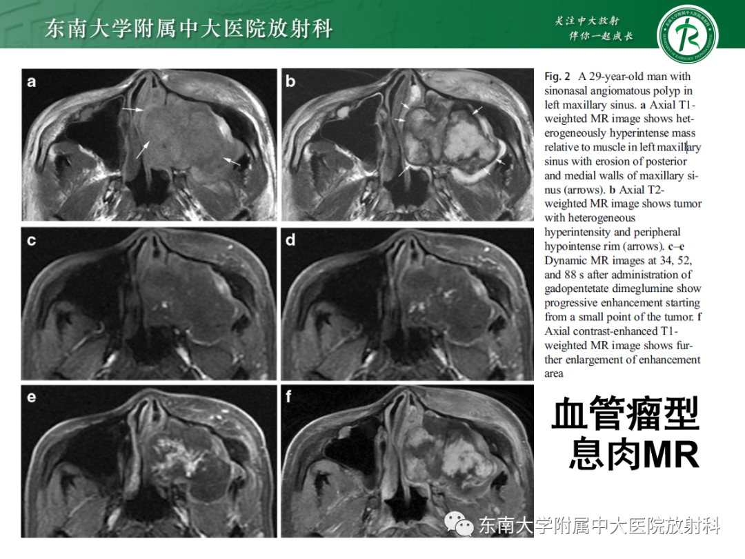 影像PPT - 【PPT】以上颌窦为中心的鼻腔鼻窦占位性病变随访-81