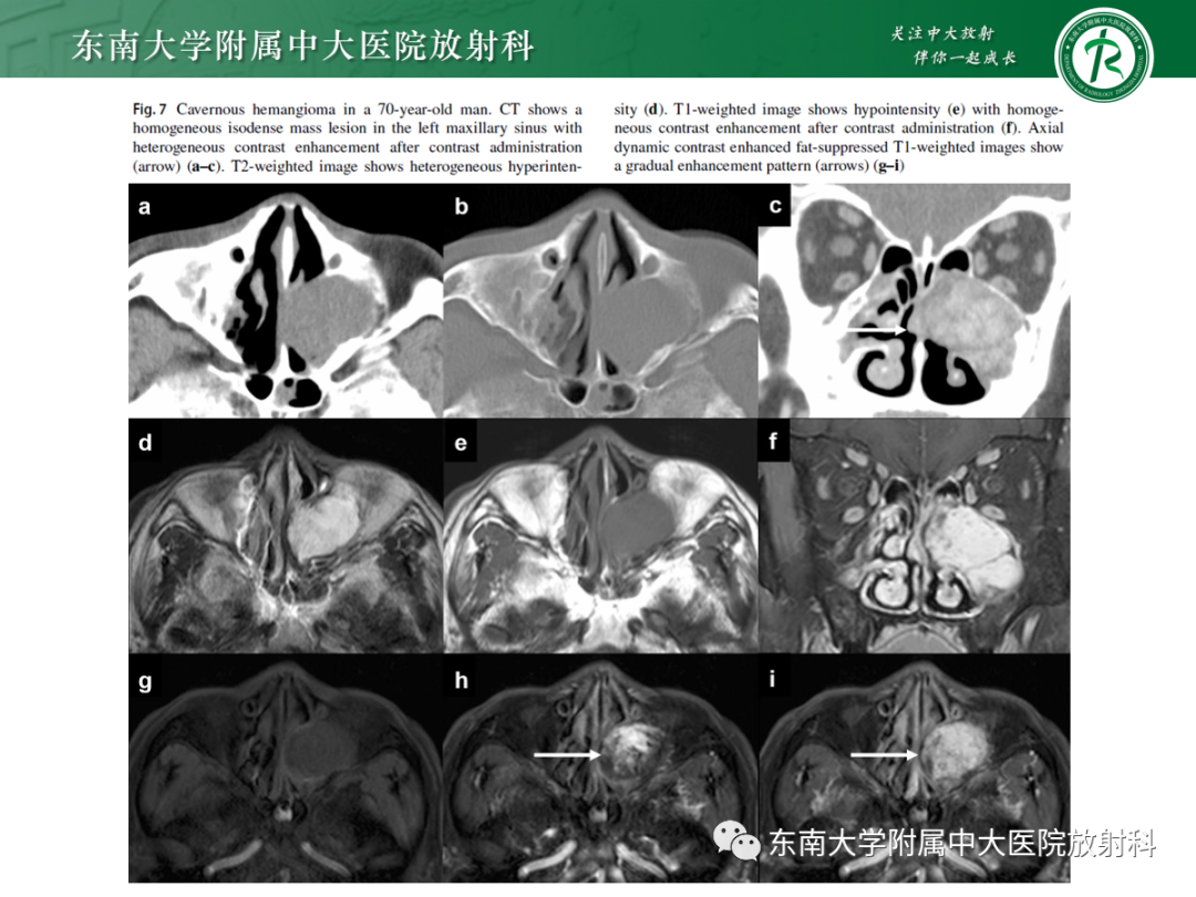 影像PPT - 【PPT】以上颌窦为中心的鼻腔鼻窦占位性病变随访-83