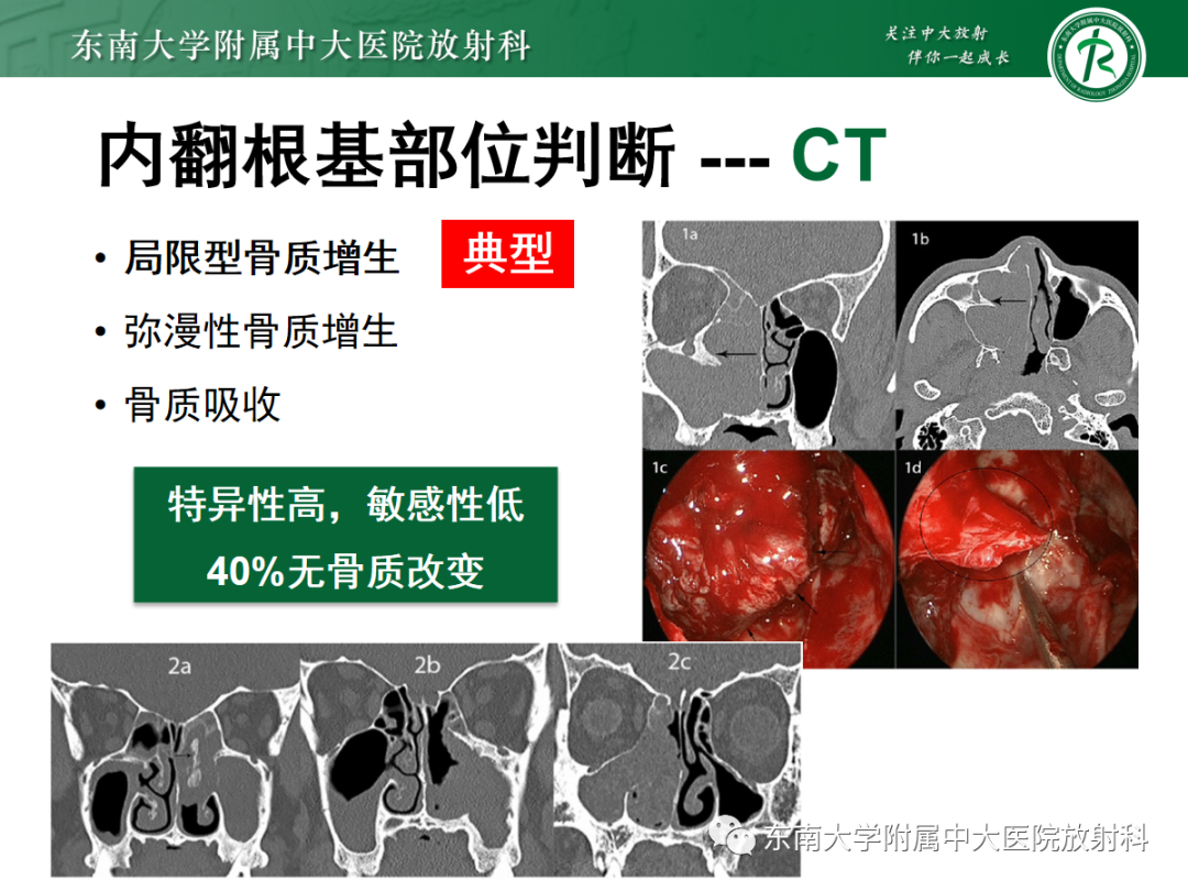影像PPT - 【PPT】以上颌窦为中心的鼻腔鼻窦占位性病变随访-87
