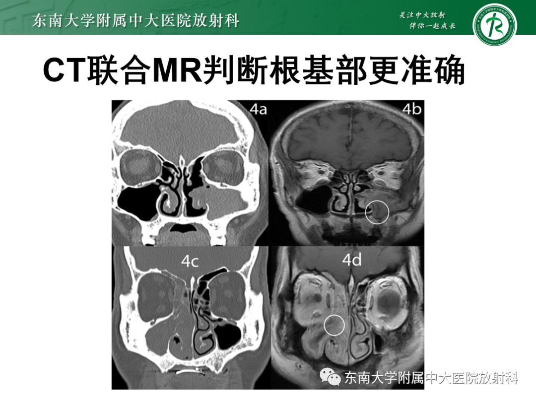 影像PPT - 【PPT】以上颌窦为中心的鼻腔鼻窦占位性病变随访-89