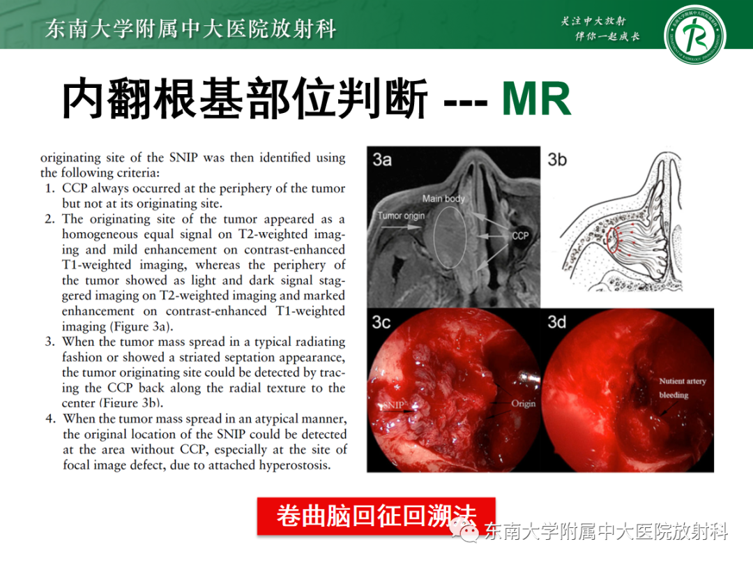 影像PPT - 【PPT】以上颌窦为中心的鼻腔鼻窦占位性病变随访-88