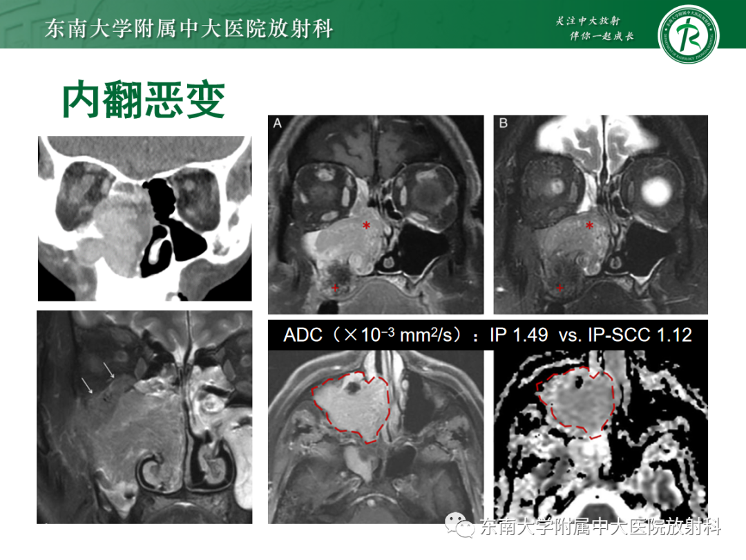 影像PPT - 【PPT】以上颌窦为中心的鼻腔鼻窦占位性病变随访-92