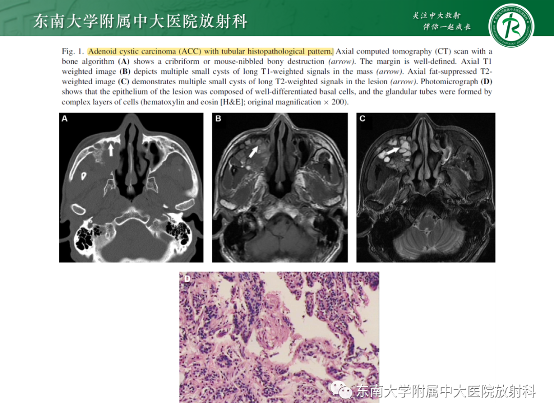 影像PPT - 【PPT】以上颌窦为中心的鼻腔鼻窦占位性病变随访-100