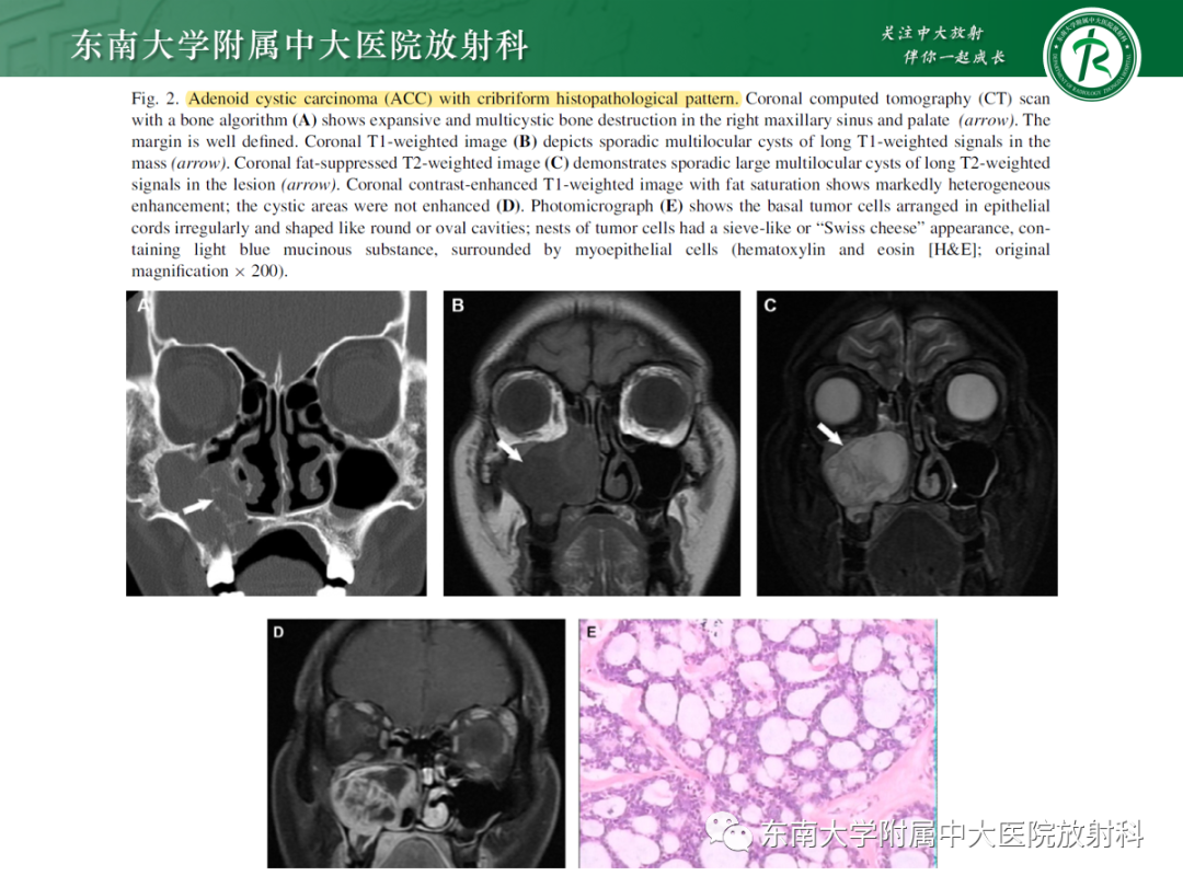 影像PPT - 【PPT】以上颌窦为中心的鼻腔鼻窦占位性病变随访-101