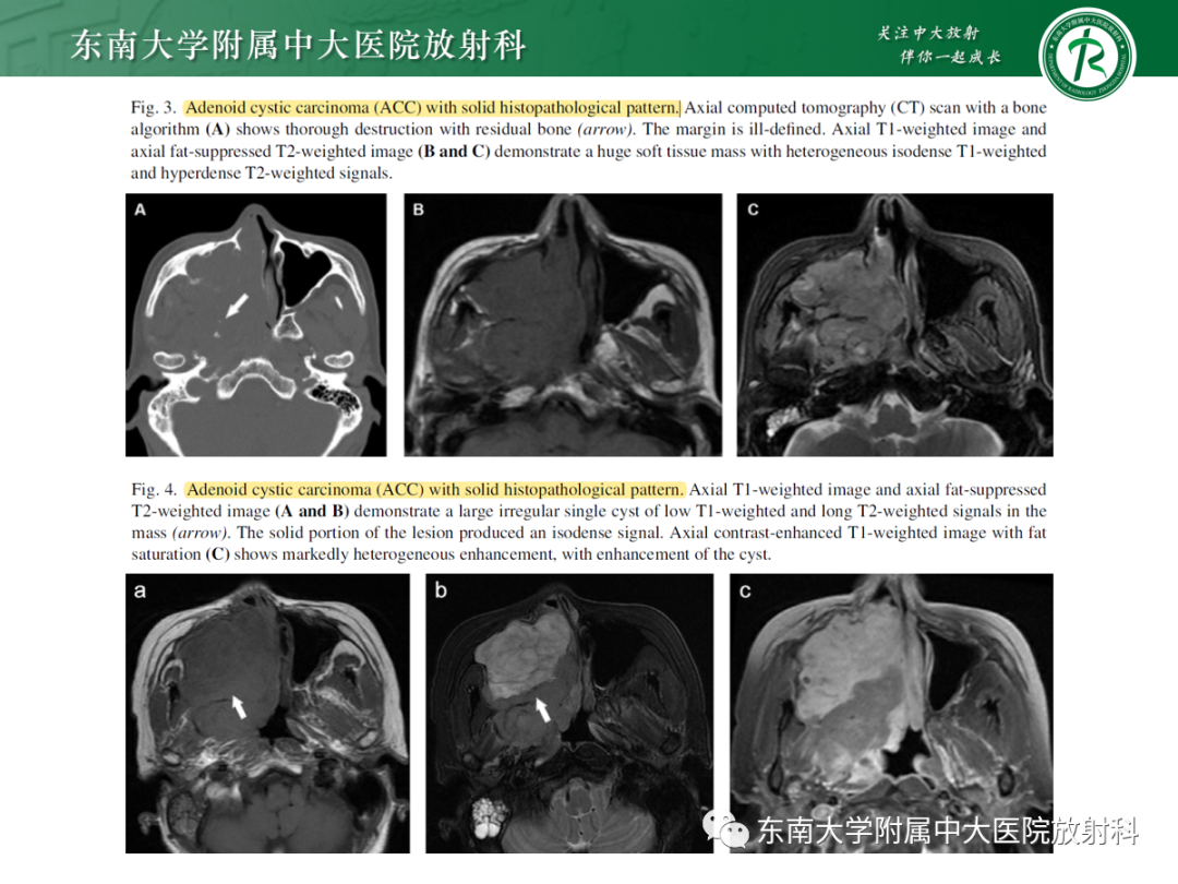 影像PPT - 【PPT】以上颌窦为中心的鼻腔鼻窦占位性病变随访-102