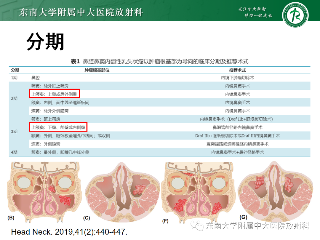 影像PPT - 【PPT】以上颌窦为中心的鼻腔鼻窦占位性病变随访-1