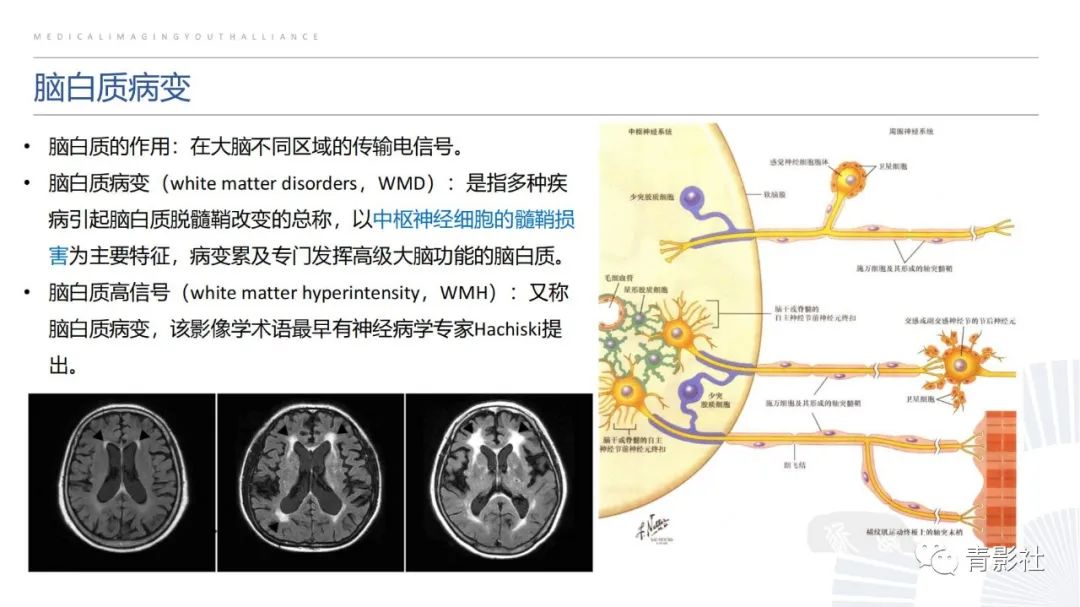 影像PPT - 【PPT】脑白质病变的影像诊断思路-6