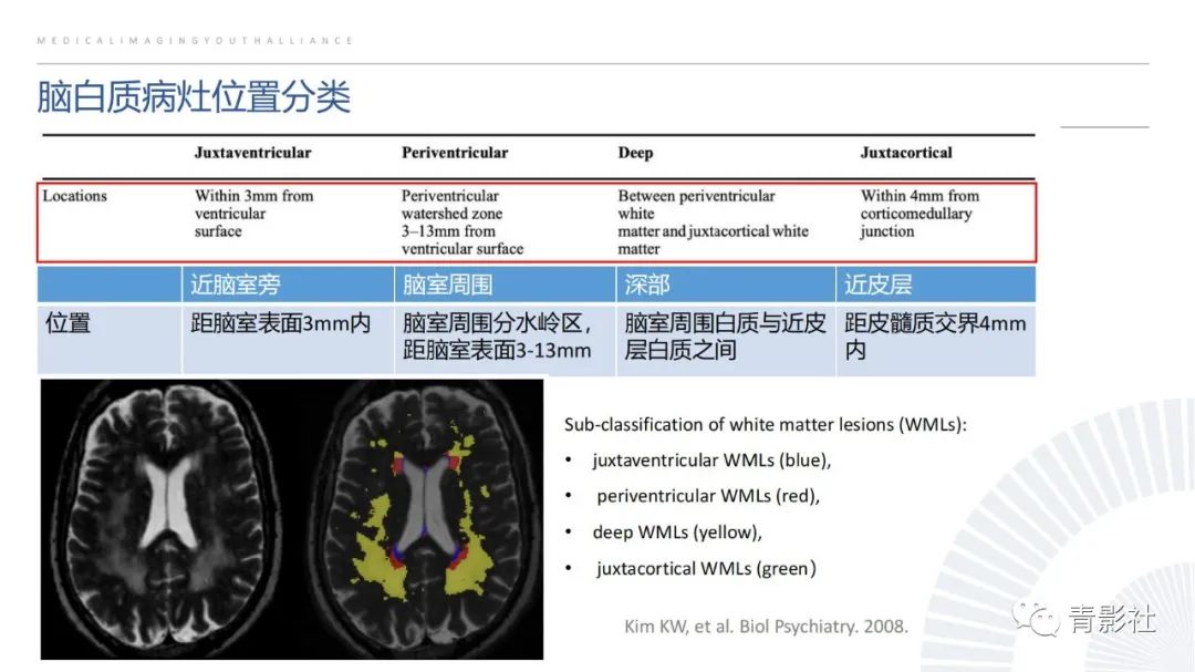 影像PPT - 【PPT】脑白质病变的影像诊断思路-8