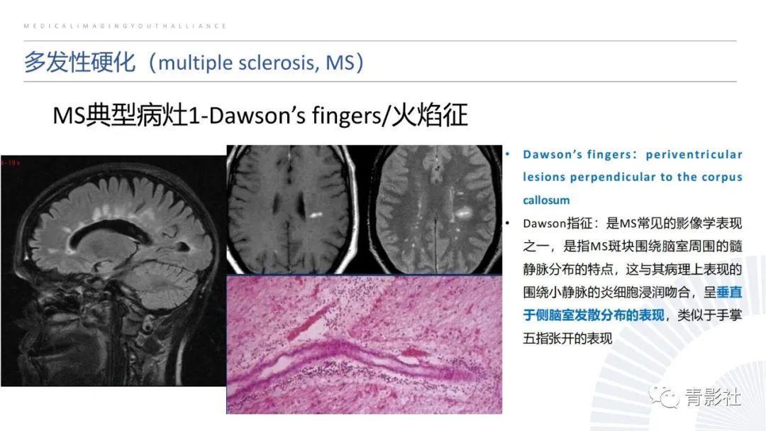 影像PPT - 【PPT】脑白质病变的影像诊断思路-10