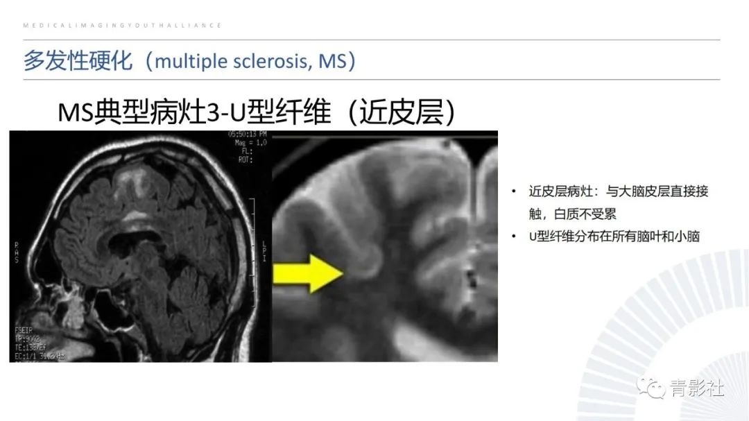影像PPT - 【PPT】脑白质病变的影像诊断思路-12