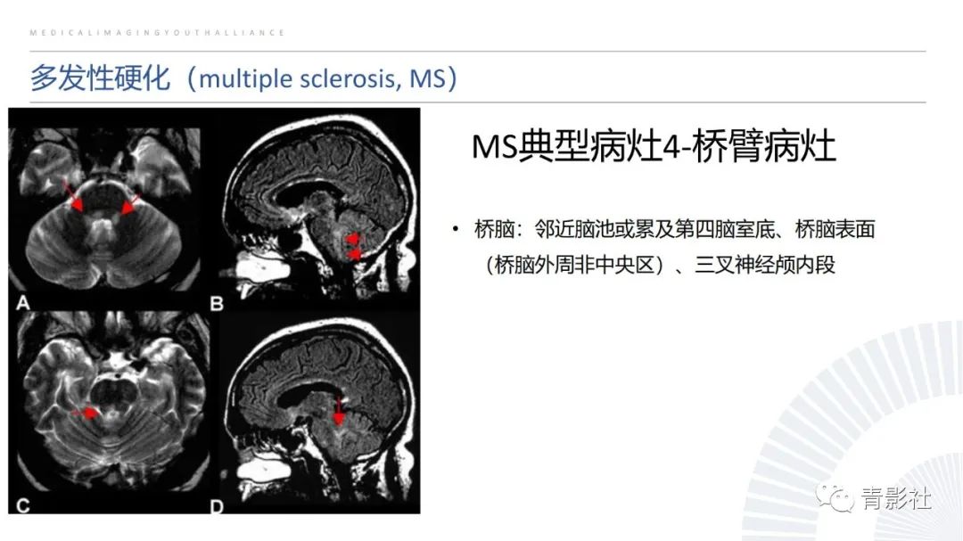 影像PPT - 【PPT】脑白质病变的影像诊断思路-13