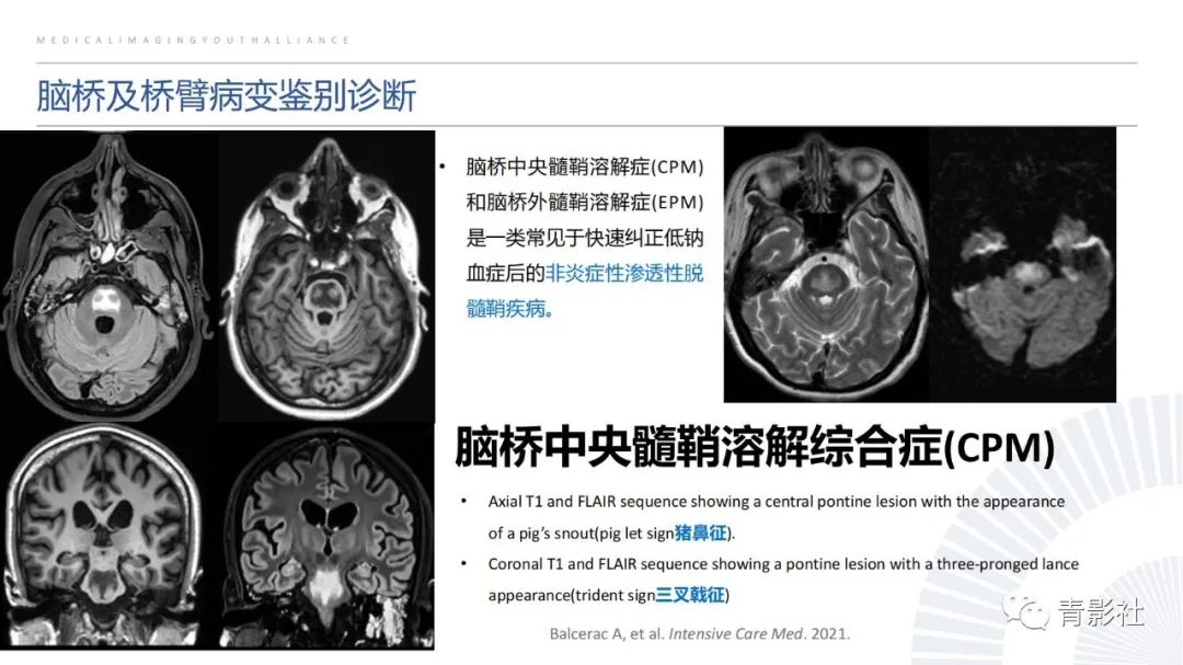 影像PPT - 【PPT】脑白质病变的影像诊断思路-14