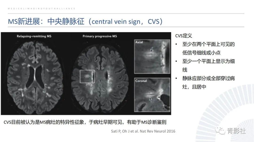 影像PPT - 【PPT】脑白质病变的影像诊断思路-15