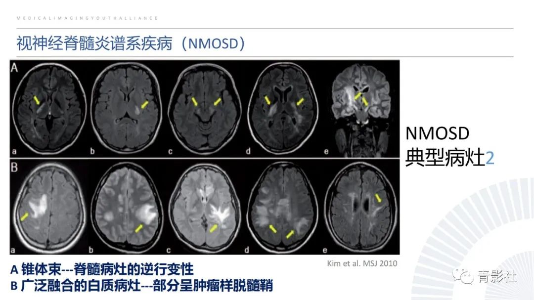 影像PPT - 【PPT】脑白质病变的影像诊断思路-18