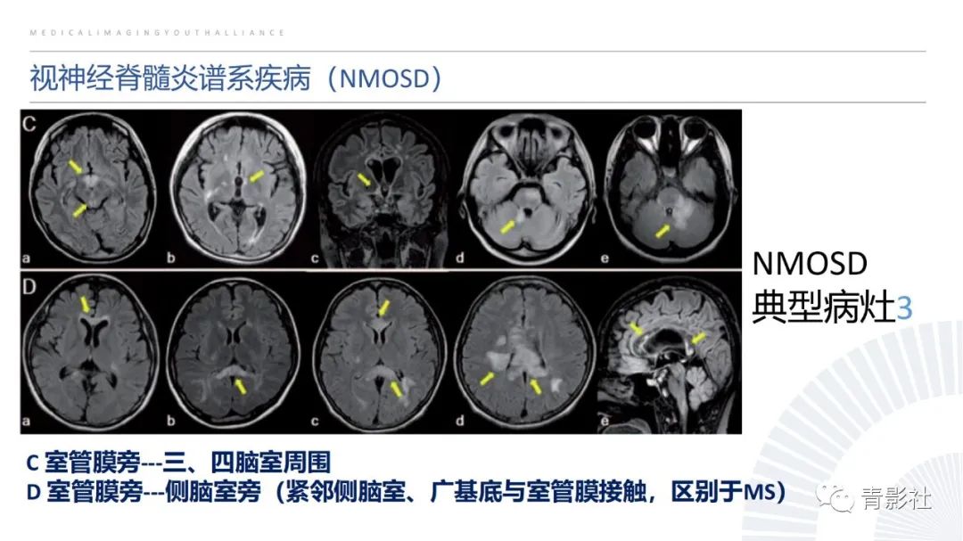 影像PPT - 【PPT】脑白质病变的影像诊断思路-19