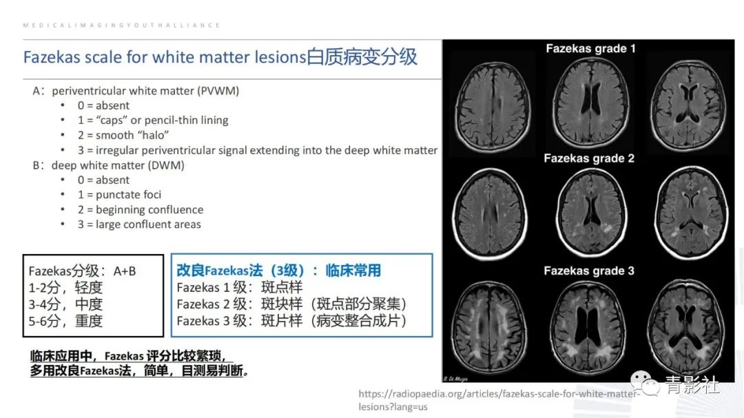 影像PPT - 【PPT】脑白质病变的影像诊断思路-25