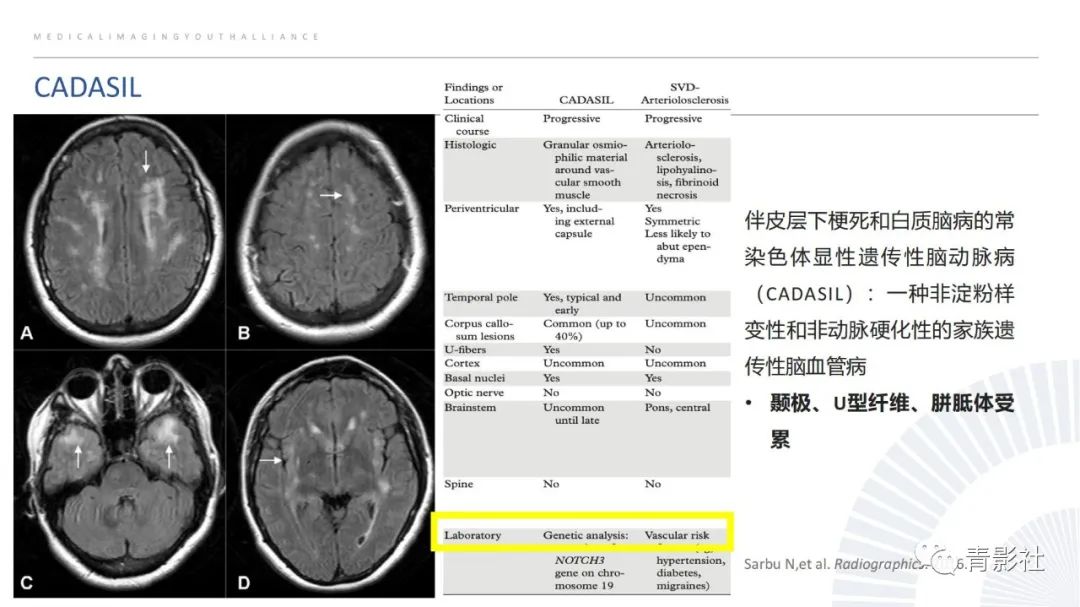 影像PPT - 【PPT】脑白质病变的影像诊断思路-29