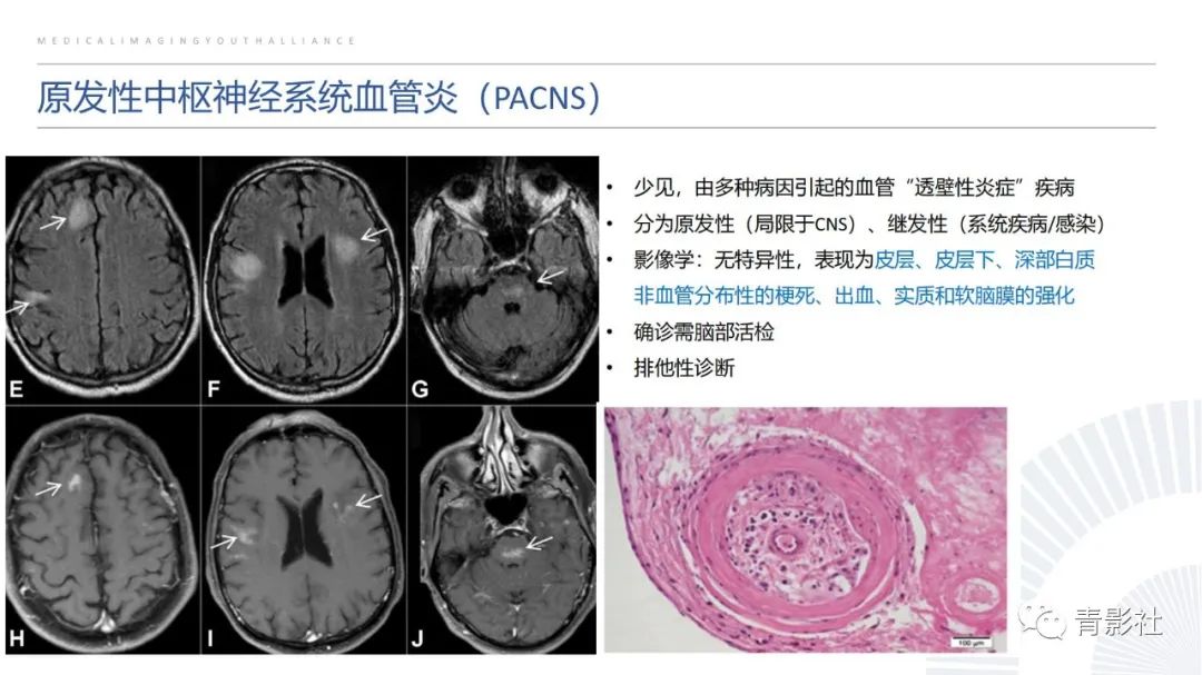 影像PPT - 【PPT】脑白质病变的影像诊断思路-30