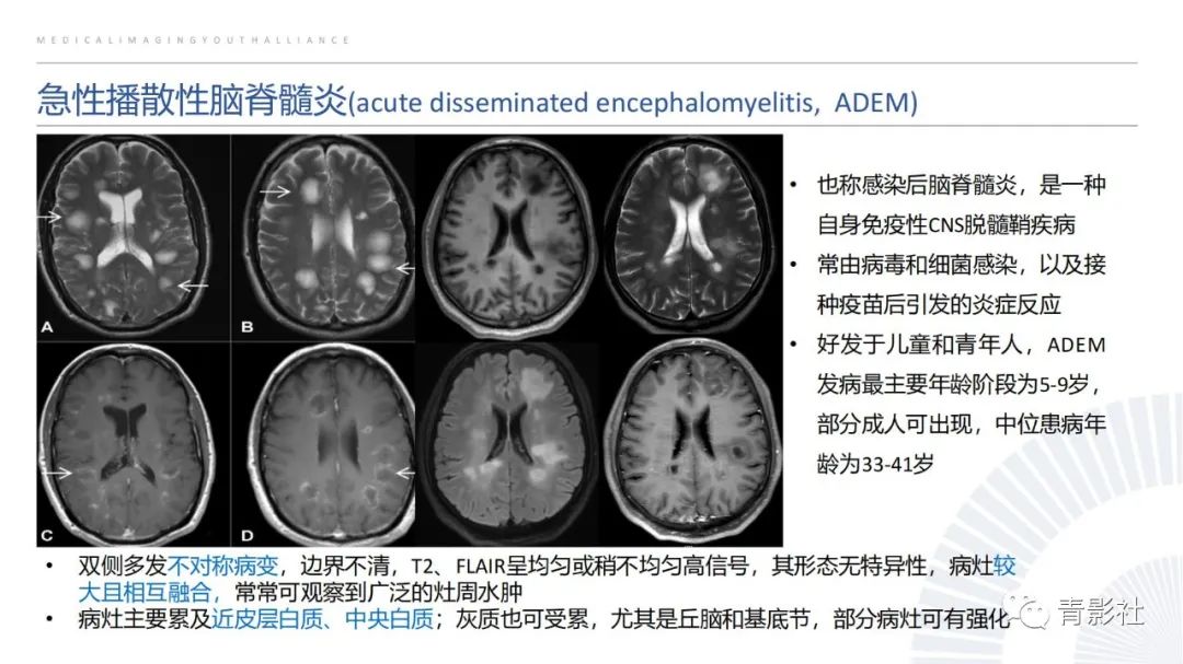 影像PPT - 【PPT】脑白质病变的影像诊断思路-31