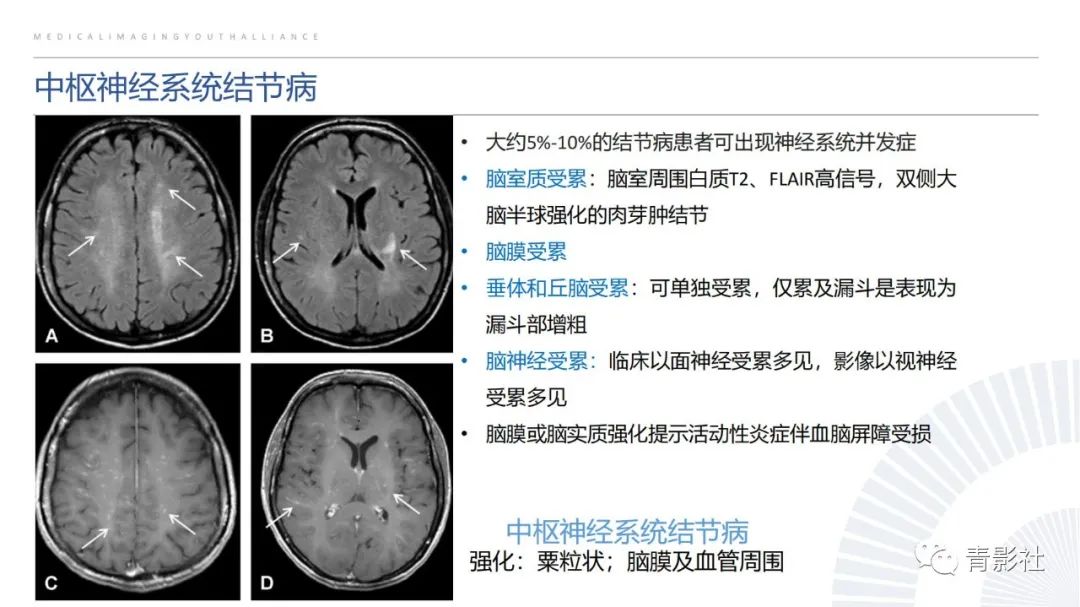 影像PPT - 【PPT】脑白质病变的影像诊断思路-32