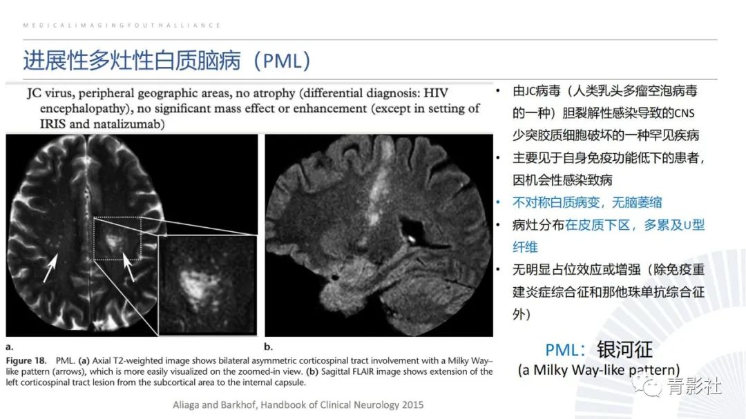影像PPT - 【PPT】脑白质病变的影像诊断思路-33
