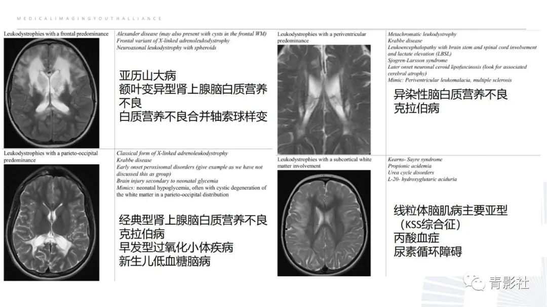 影像PPT - 【PPT】脑白质病变的影像诊断思路-35