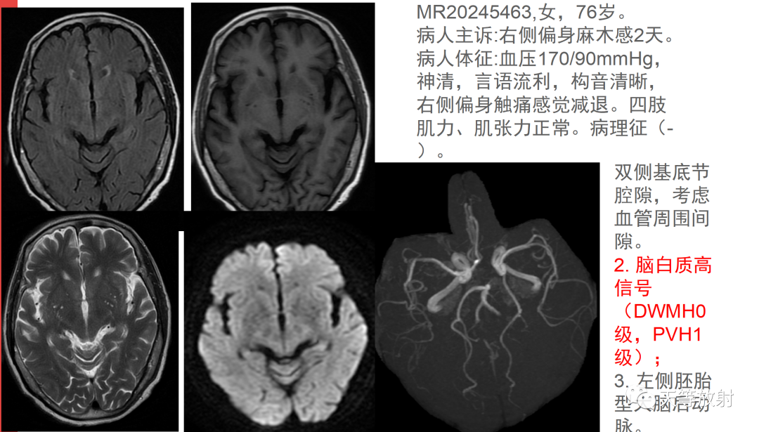 影像PPT - 脑白质病变-4 影像PPT - 脑白质病变-4