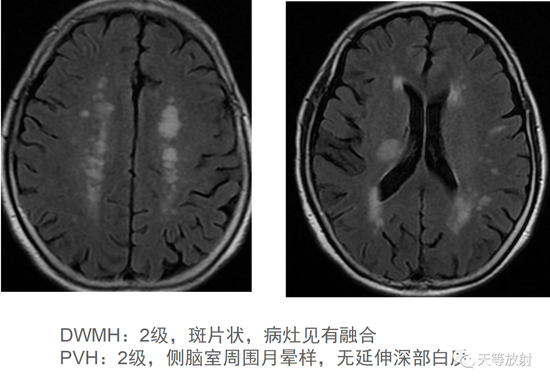 影像PPT - 脑白质病变-3 影像PPT - 脑白质病变-3