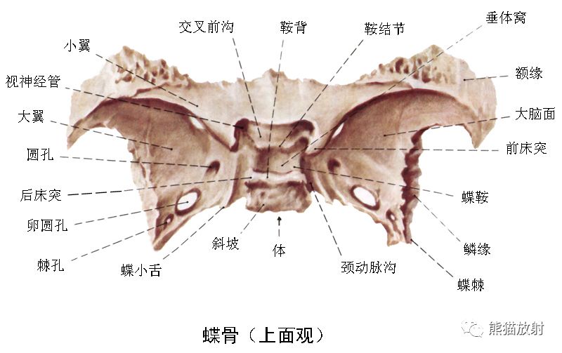 影像PPT - 蝶骨大翼解剖及相关疾病-2 影像PPT - 蝶骨大翼解剖及相关疾病-2