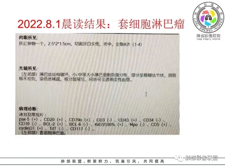 影像PPT - 【病例】小细胞肺癌?套细胞淋巴瘤?-23 影像PPT - 【病例】小细胞肺癌?套细胞淋巴瘤?-23