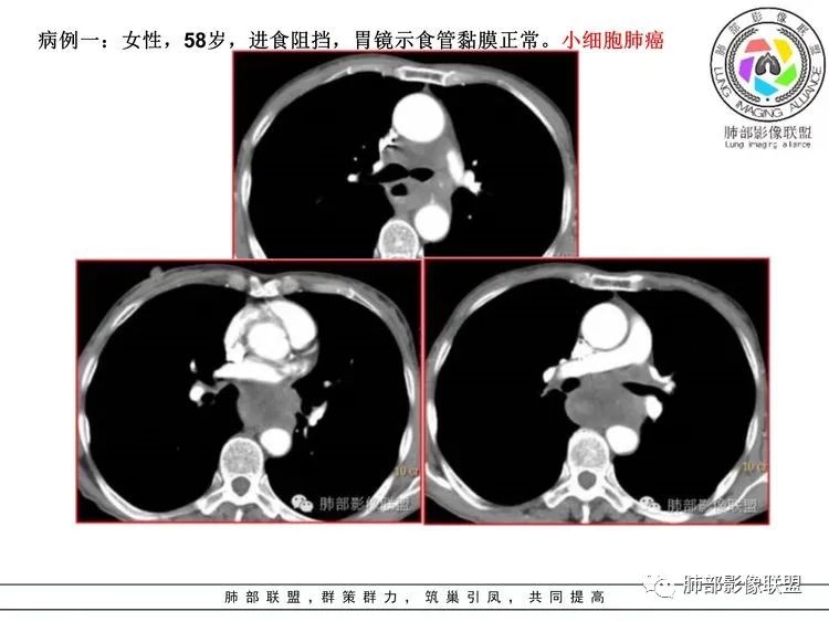 影像PPT - 【病例】小细胞肺癌?套细胞淋巴瘤?-26 影像PPT - 【病例】小细胞肺癌?套细胞淋巴瘤?-26