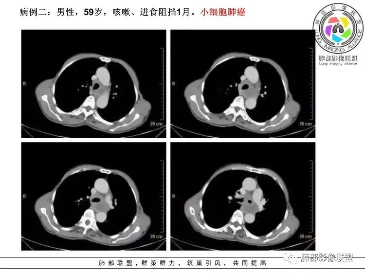 影像PPT - 【病例】小细胞肺癌?套细胞淋巴瘤?-27 影像PPT - 【病例】小细胞肺癌?套细胞淋巴瘤?-27