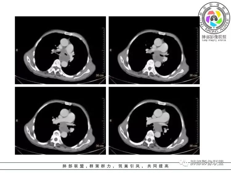 影像PPT - 【病例】小细胞肺癌?套细胞淋巴瘤?-28 影像PPT - 【病例】小细胞肺癌?套细胞淋巴瘤?-28