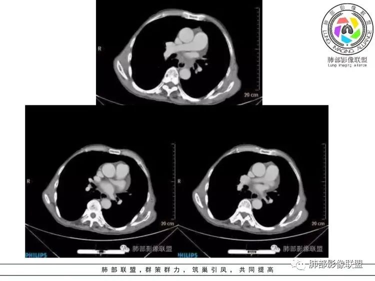 影像PPT - 【病例】小细胞肺癌?套细胞淋巴瘤?-29 影像PPT - 【病例】小细胞肺癌?套细胞淋巴瘤?-29