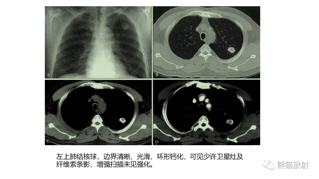 影像PPT - 【病例】肺原位腺癌 VS 浸润性腺癌-15