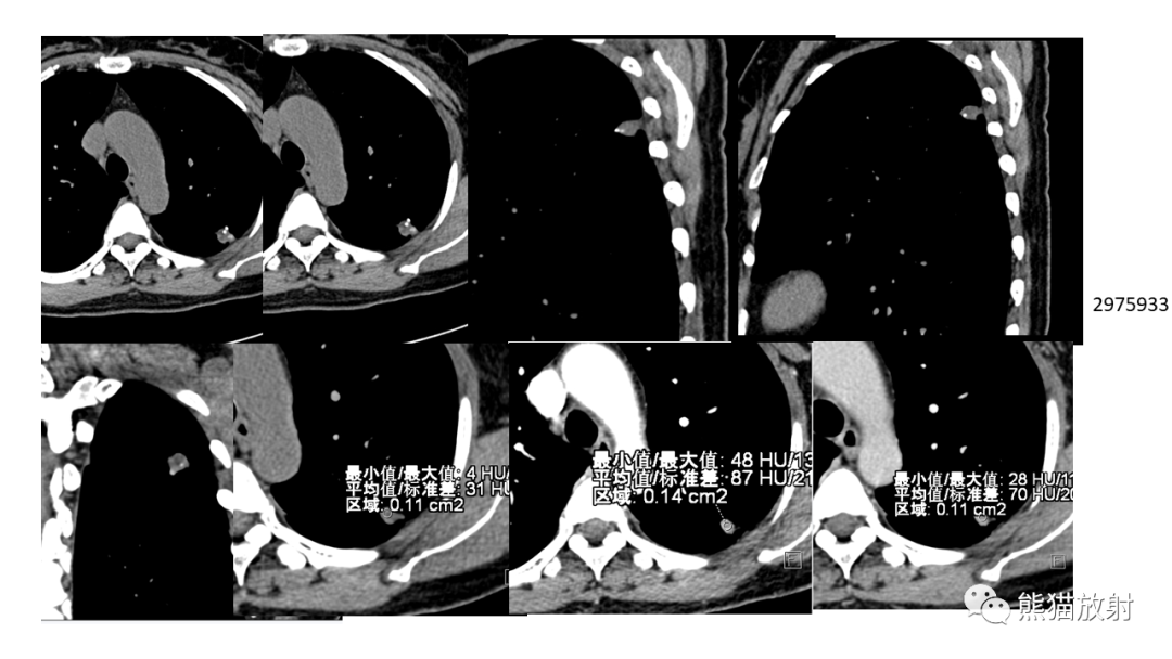 影像PPT - 【病例】肺原位腺癌 VS 浸润性腺癌-22