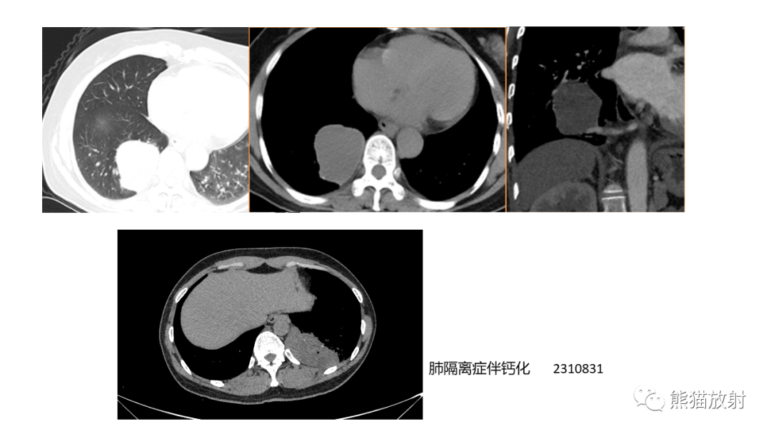 影像PPT - 【病例】肺原位腺癌 VS 浸润性腺癌-24