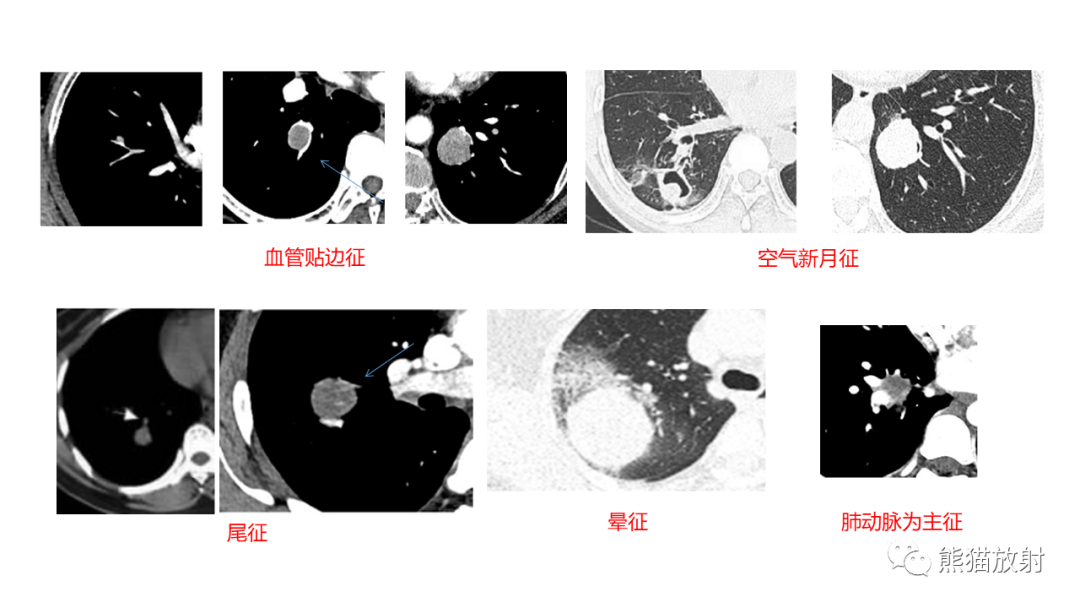 影像PPT - 【病例】肺原位腺癌 VS 浸润性腺癌-26