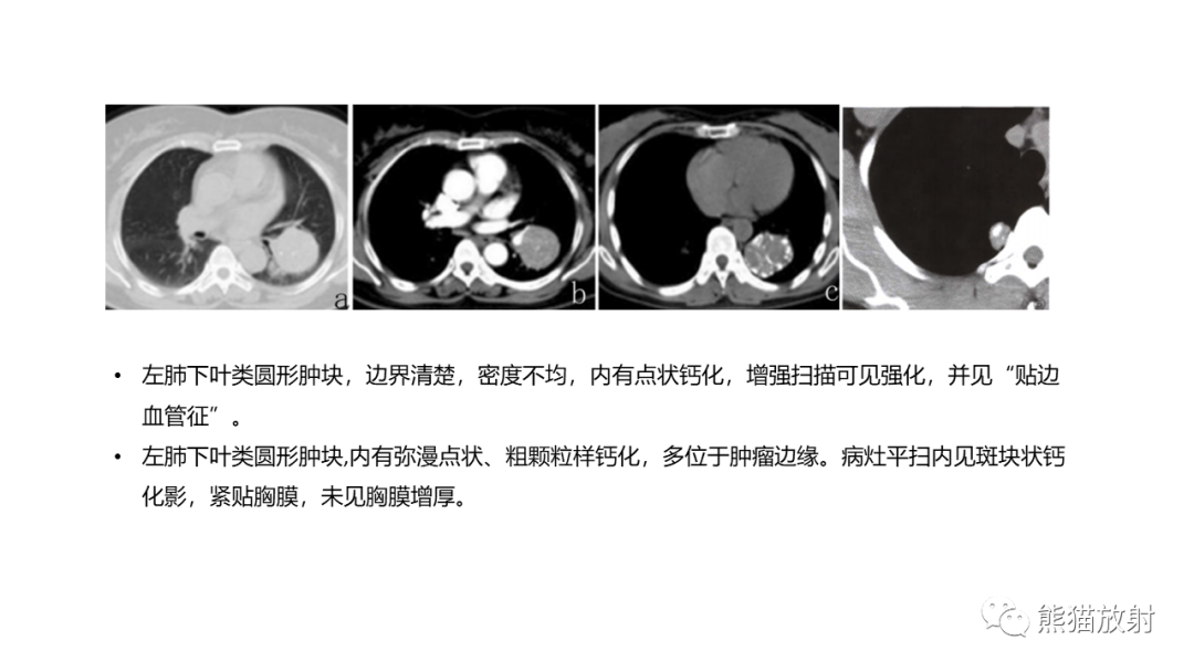 影像PPT - 【病例】肺原位腺癌 VS 浸润性腺癌-27