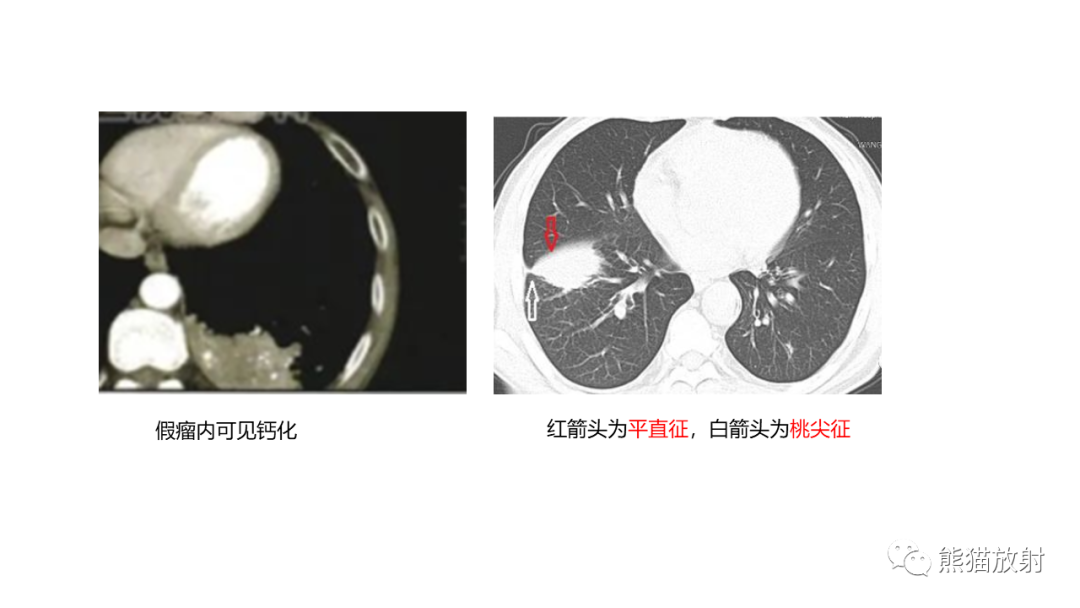 影像PPT - 【病例】肺原位腺癌 VS 浸润性腺癌-29